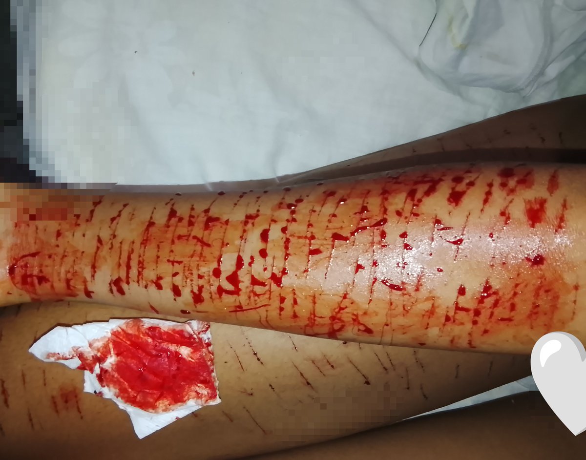 cherryred3214's tweet photo. Primer intento de llenarme el brazo :'v
#makeup #fakeblood #shdtwtt #shtwtt
SFX MAKEUP
ALL FAKE
FAKE BLOOD https://t.co/LeIkqtf311