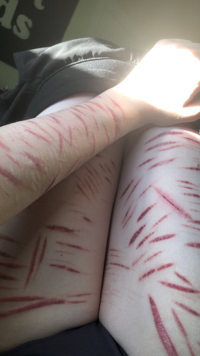 M4dforl1fe's tweet photo. Standing all day has turned some of my scars a weird purple colour lol (HEALEDDDD EVERYTHING) #slittttwt https://t.co/YAF3qo7JgD