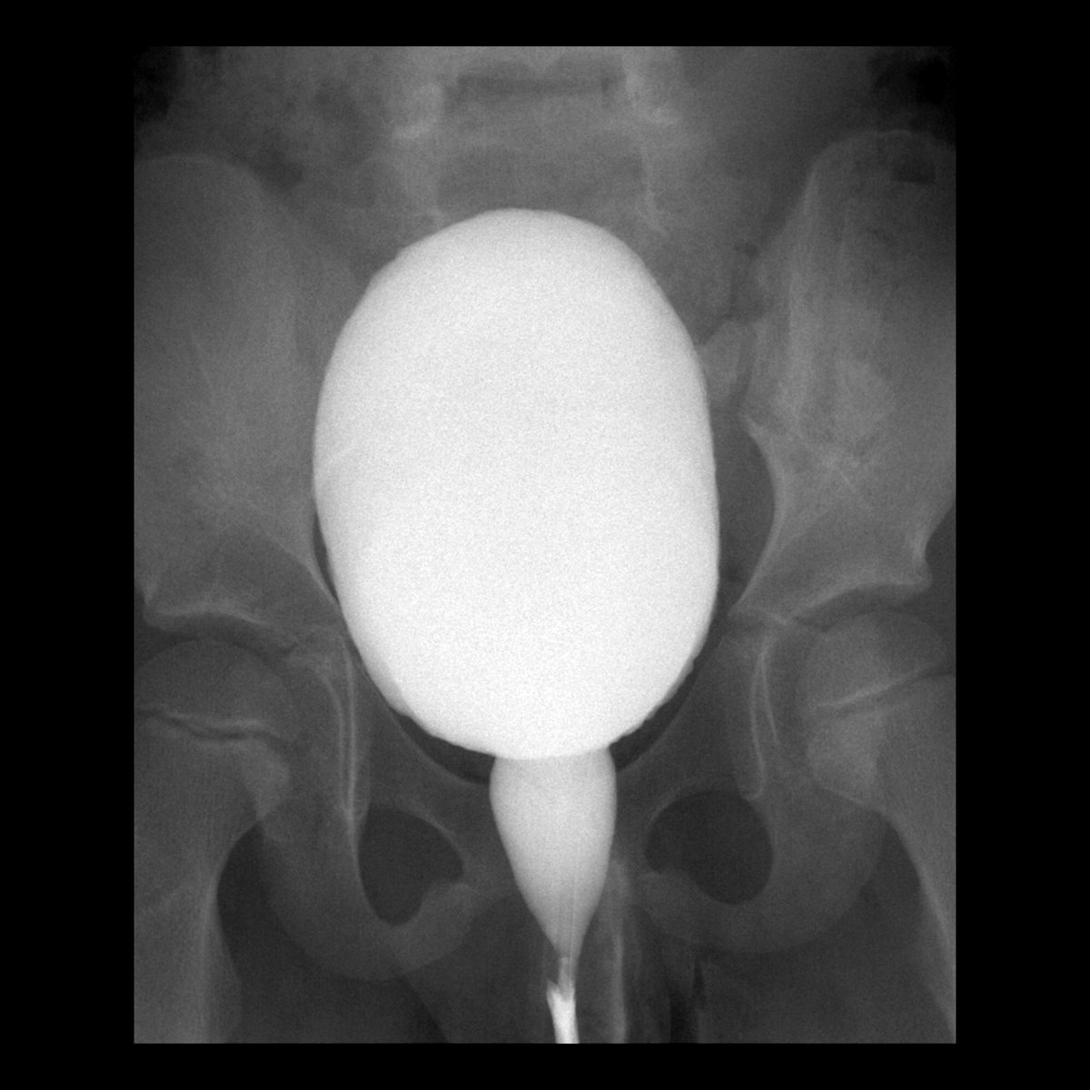 pedsimaging's tweet photo. School ager with urinary tract infection
AP image from voiding cystourethrogram during voiding shows a non-obstructive ellipsoid-shaped dilation of posterior urethra just distal to internal urethral sphincter
#FOAMed #MedEd #FOAMRad #PedsRad #RadEd #radiology #radiologia https://t.co/tFy11S7bCQ
