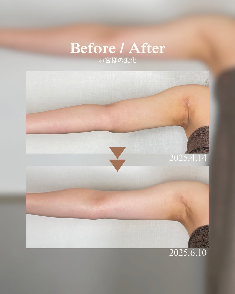 INDIBA_OnpaLabo's tweet photo. これ、同じ二の腕です。

クリニック：（韓国）Re:SLIM CLINIC様
手術部位：二の腕脂肪吸引

Beforeでは二の腕中央〜肘にかけてボリュームがありましたが、Afterではすっきりとしたラインに。

二の腕脂肪吸引は「どれだけ細くなったか」だけじゃなく、横から見たラインも見てほしいポイント。 https://t.co/3DrtGbj6Ba