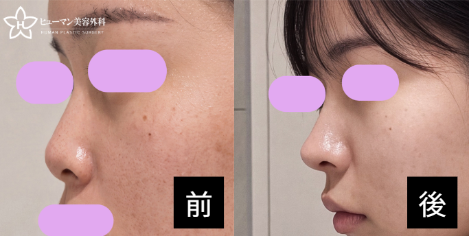 humanpsjp's tweet photo. 【ヒューマン美容外科｜鼻整形症例】

初鼻整形｜キム・グクヒョン代表院長

鼻筋：3Dシリコン
鼻先：自家肋軟骨
骨切り＋団子鼻修正
✨ 術後約7ヶ月

📩 LINE：humansjp

📷 症例の詳細はこちら
https://t.co/6HerKdA08r

#鼻整形 #鼻整形症例 #ヒューマン美容外科 https://t.co/tdyGEPyogK