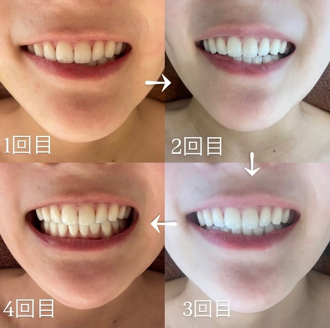 salonzayon's tweet photo. こんな気圧の日こそ脂肪吸引して時間がたっても浮腫やすかったり、麻痺のこわばり強くでたりしていませんか？ザヨンは鍼灸だけでなく医療機器も合わせて、お悩みにあわせた施術をしています！
https://t.co/Zqz1B51Jos https://t.co/ORWsEKBCDr