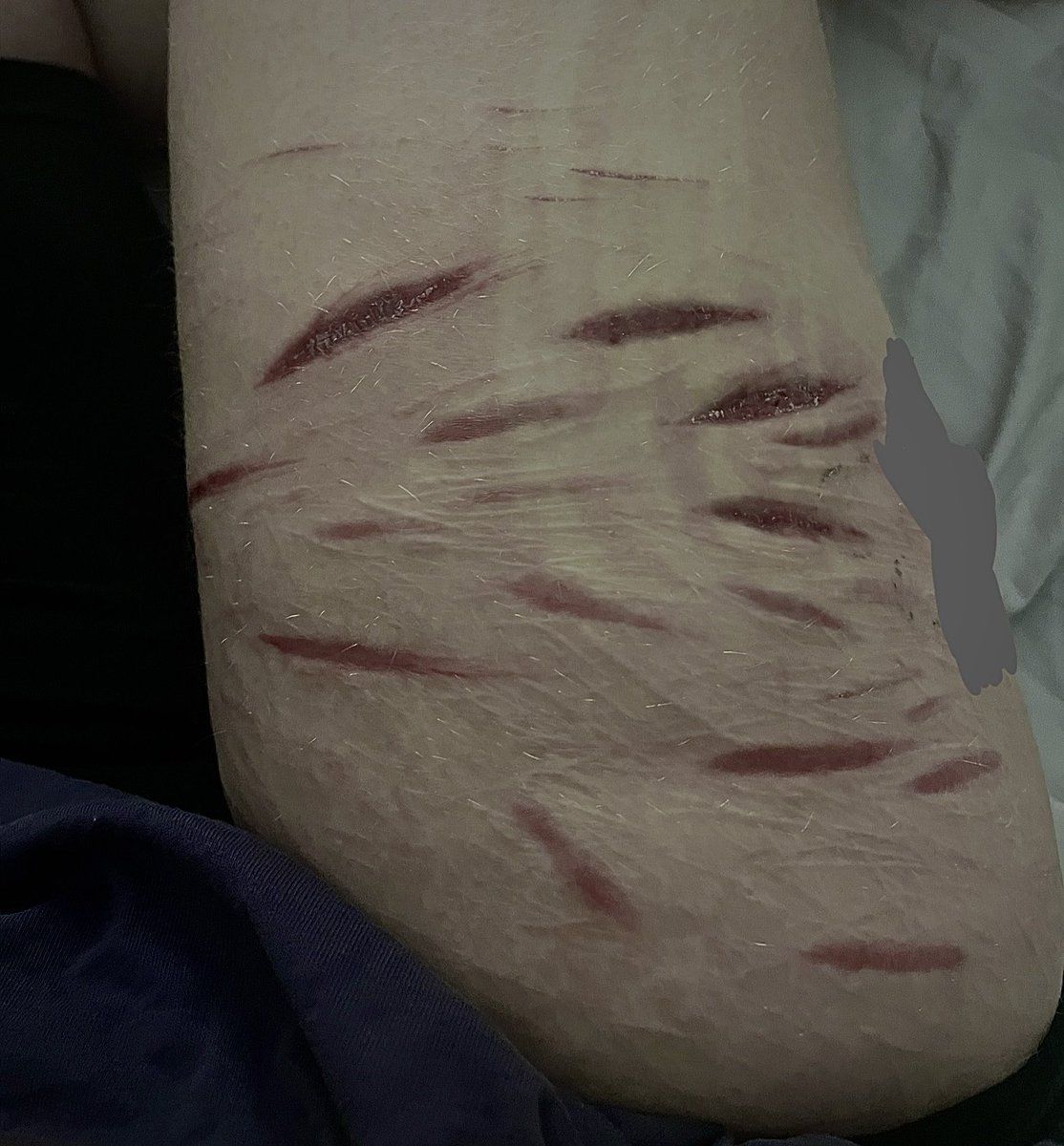 ghostbustingxx's tweet photo. HEALED scar check 

covered up the healing one cuz Nasty!

#shedrtwt https://t.co/bo9bBD4kQU