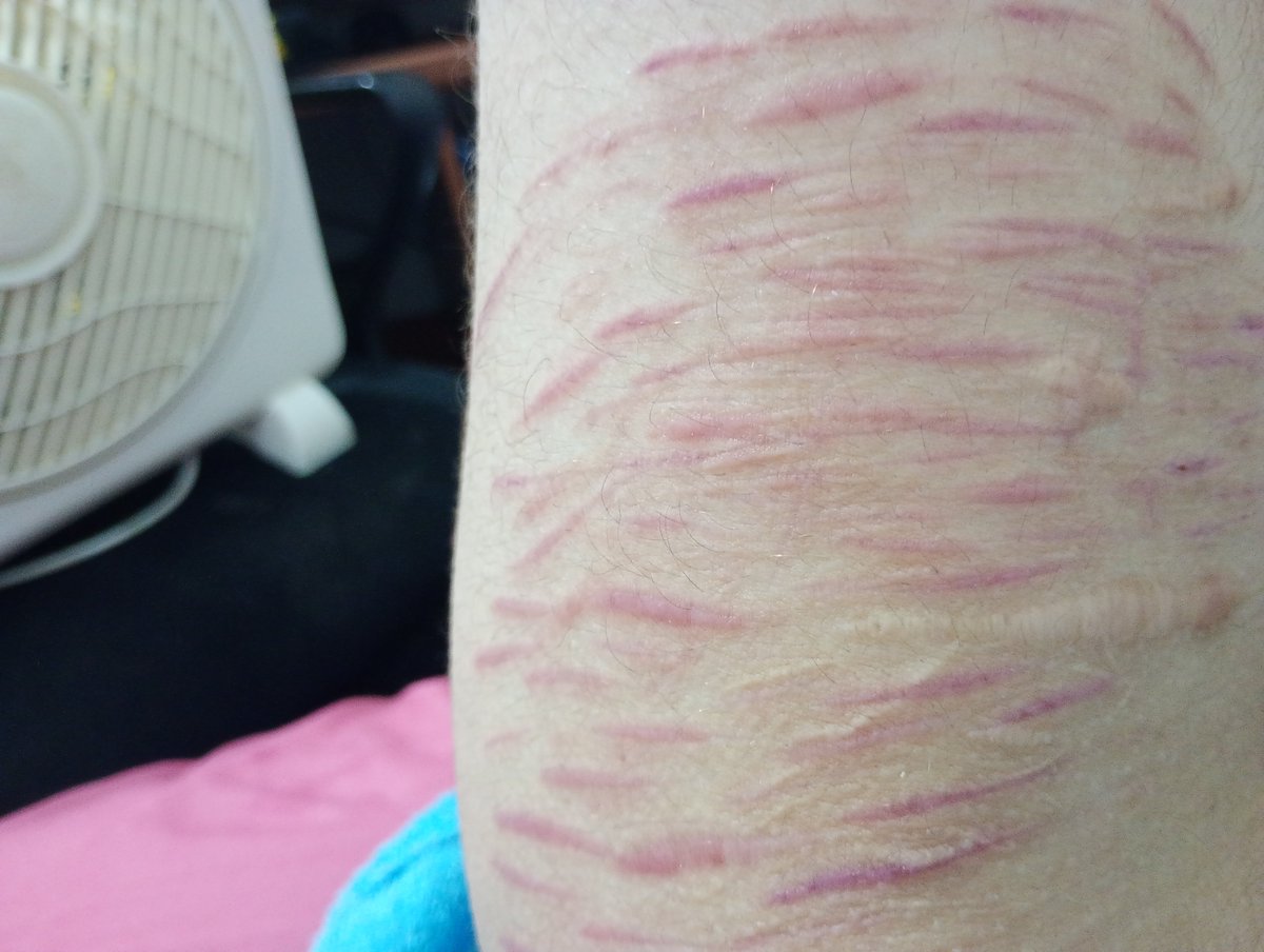 Kallender1411's tweet photo. I'm so glad the scars on my left leg are fading. This better be dcarspo please
#scarspo #shtwt #ouchtwt #AIart️️️️️️️️️️️️️️️️️️️️️️️️️️️️️️️️️️️️️️️️️ #sfxmakeup
#shedtwtt #shtwtt #slittwt #988twt https://t.co/KUTbYcMS43