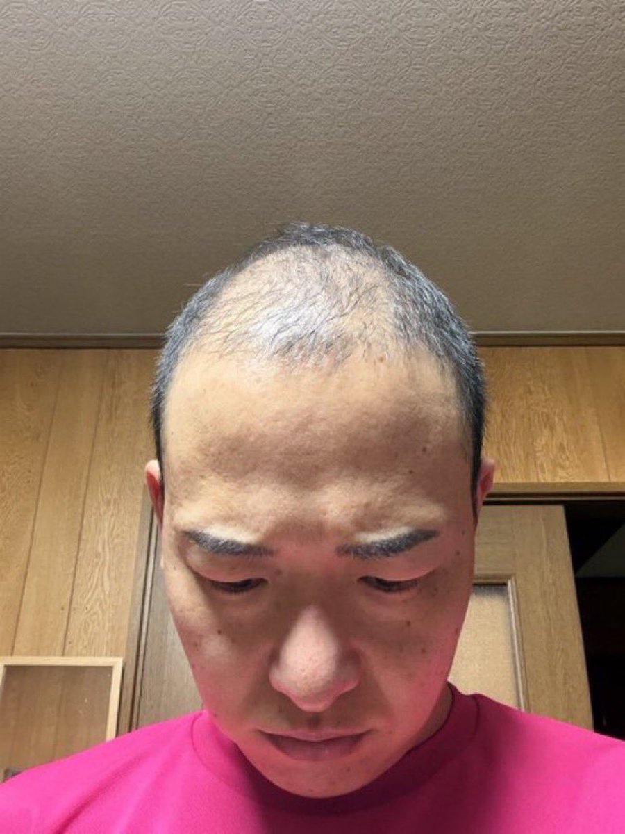 sakabe_youtube's tweet photo. 現役の楽天社員です。
月末、追い込みすぎて髪の毛が薄くなった気がします。全ては楽天モバイルナンバーワンキャリアのために。 https://t.co/pxMIyLl3gq