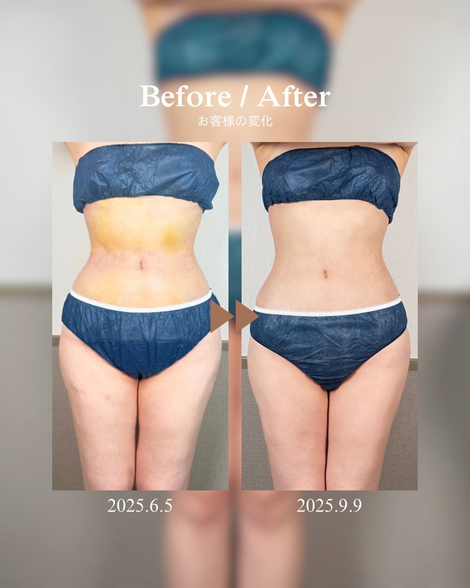 INDIBA_OnpaLabo's tweet photo. 「お腹が細くなった」だけじゃない。

腹部＋腰の脂肪吸引Before / After。

クリニック：湘南美容外科 梅田院 様
手術部位：腹部 腰 脂肪吸引

お腹まわりのボリュームだけでなく、
ウエストのくびれや腰からお腹にかけてのラインにも変化。 https://t.co/B7tbbNF0g0
