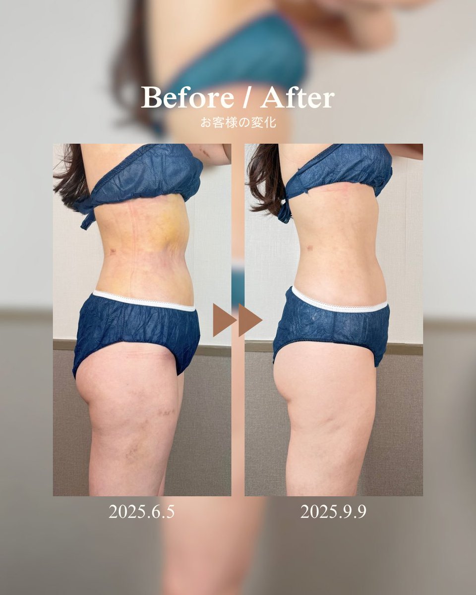 INDIBA_OnpaLabo's tweet photo. 「お腹が細くなった」だけじゃない。

腹部＋腰の脂肪吸引Before / After。

クリニック：湘南美容外科 梅田院 様
手術部位：腹部 腰 脂肪吸引

お腹まわりのボリュームだけでなく、
ウエストのくびれや腰からお腹にかけてのラインにも変化。 https://t.co/B7tbbNF0g0