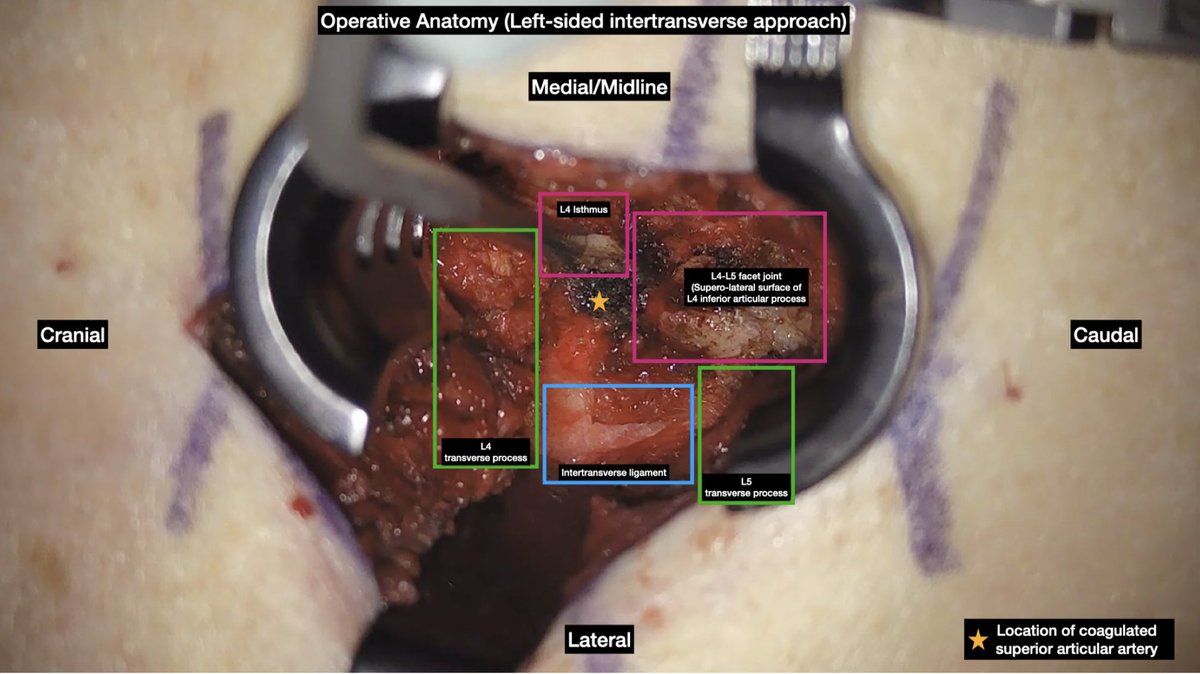 ActaNeuro's tweet photo. #OnlineFirst: How I do it: microsurgical extraforaminal sequestrectomy through a midline intertransverse approach
Check out the #OpenAccess Acta Neurochirurgica article at: https://t.co/vjNUtiosSS
#neurosurgery #sequestrectomy #intertransverse https://t.co/Sfdf3AD51U