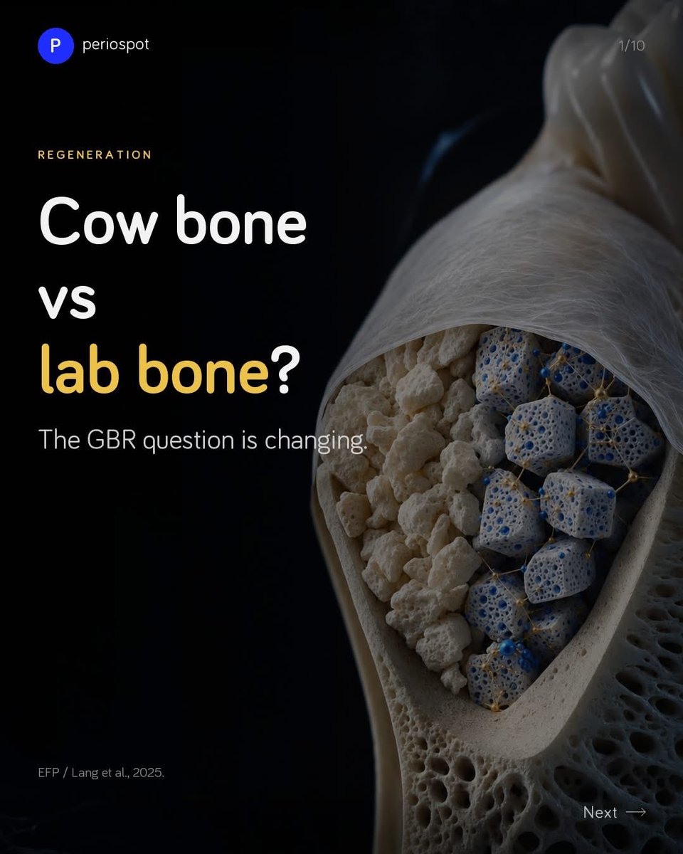 drAnasabdo's tweet photo. •what is better “Xinograft Vs Synthetic” .
•أيهما افضل الطعم البقري ام الصناعي 

Courtesy: Perio post:

#endo_prostho_ortho
#EPO
#DrABDO
•You can ask …!!

•follow me: https://t.co/hdT3Kl3UcW