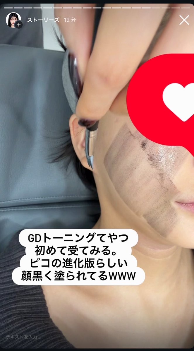 ピコトーニングの進化版GDトーニング初めて受けたんだけどすげぇ!!ww一瞬顔がガングロになるんですが、その後すぐくすみ取れてトーンアップする!!シアクリニックの美白パッケージ、チタニウム×ピコシュア×イオン導入も有りで1日で結構顔白くなるのでおすすめですん https://t.co/6gZ6RR300N