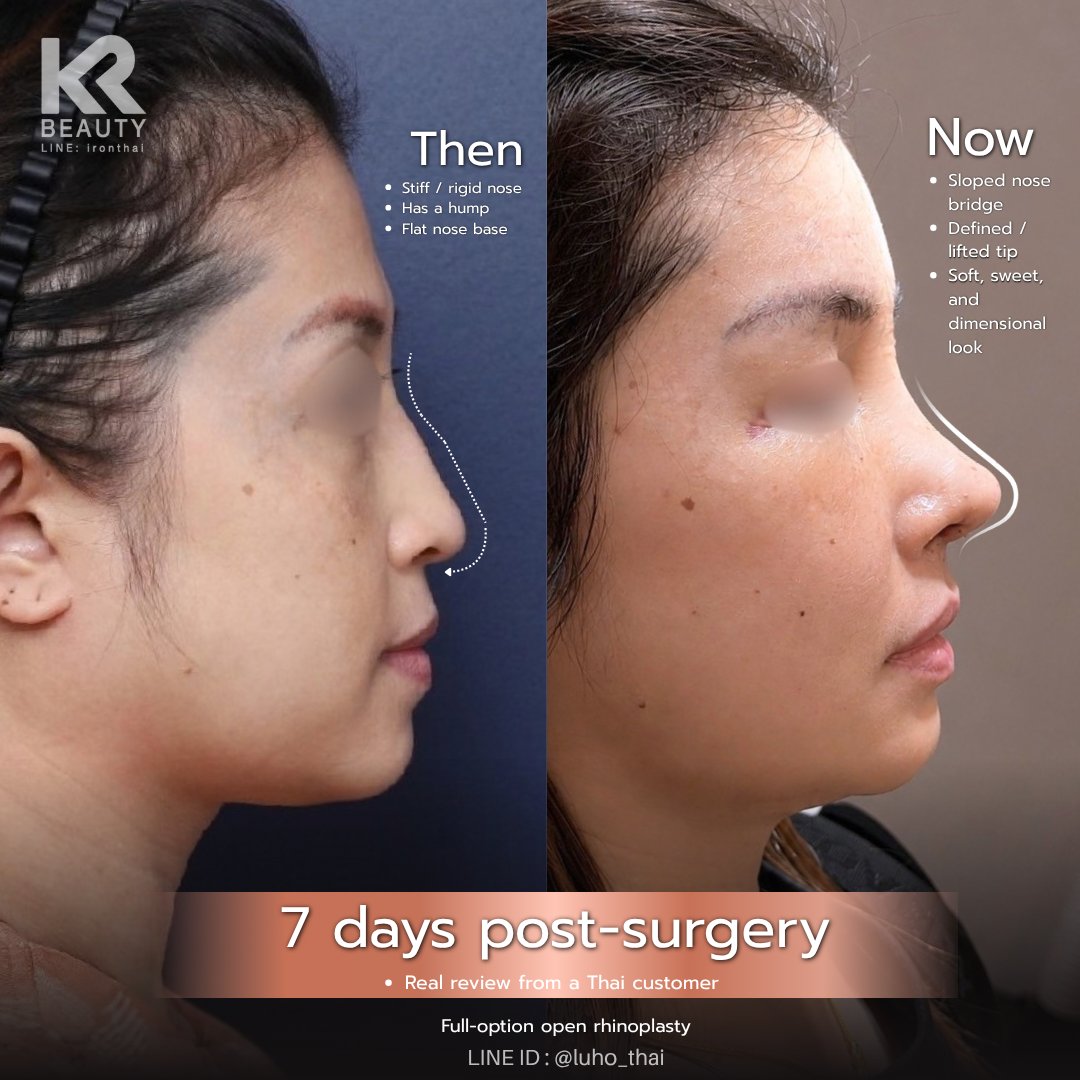 bananapsth's tweet photo. Wow!! It’s only been 7 days! 🤩💖
Anyone dealing with a stiff-looking nose, a hump, or a flat nose bridge like this case? Take a look at this review!
Just 7 days after the Full Option Open Rhinoplasty, the shape completely transformed!

📱 Line: @ironthai https://t.co/scQSRV9pVx