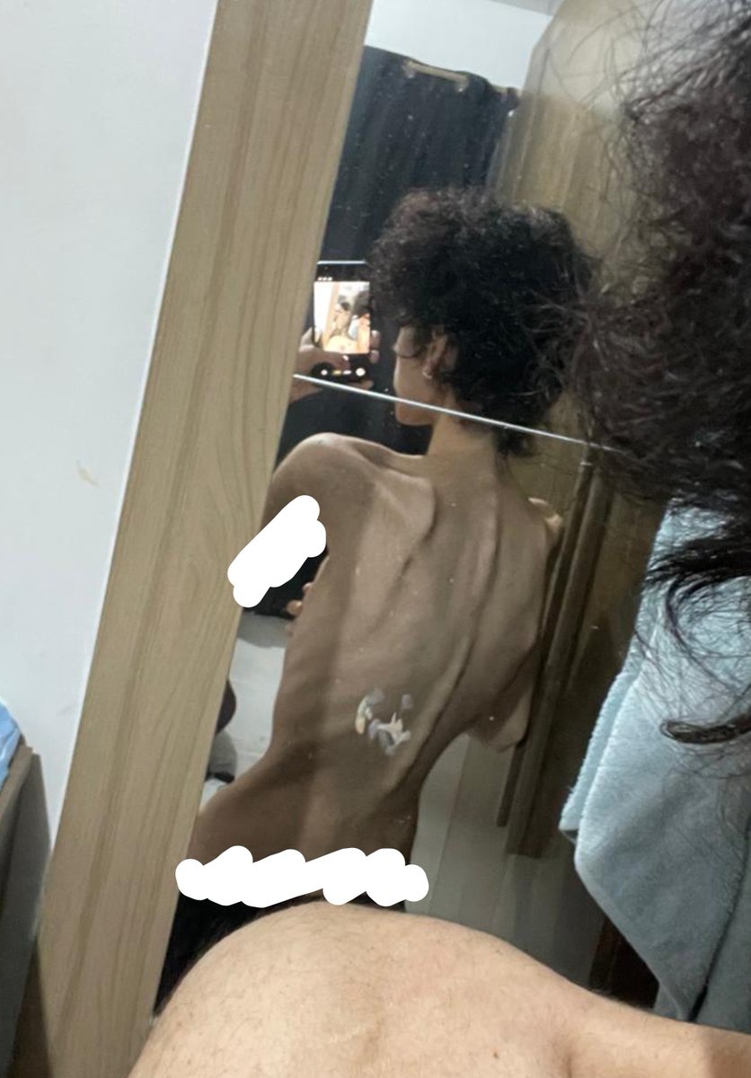 puke0kcal's tweet photo. i'm already free so whatever :p i look so fat my body is all swollen https://t.co/bBaxcCFkpe