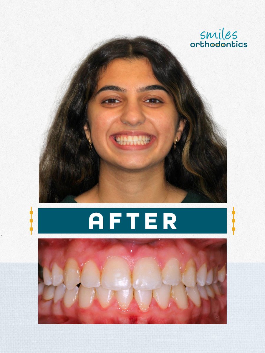 smilesortho's tweet photo. Braces off for Bahareh! 💙 We’re so happy to celebrate your beautiful smile with you at Smiles Orthodontics. Keep smiling! 😁

#BracesOff #Orthodontics #WichitaKS https://t.co/Y1rkl0dlxV