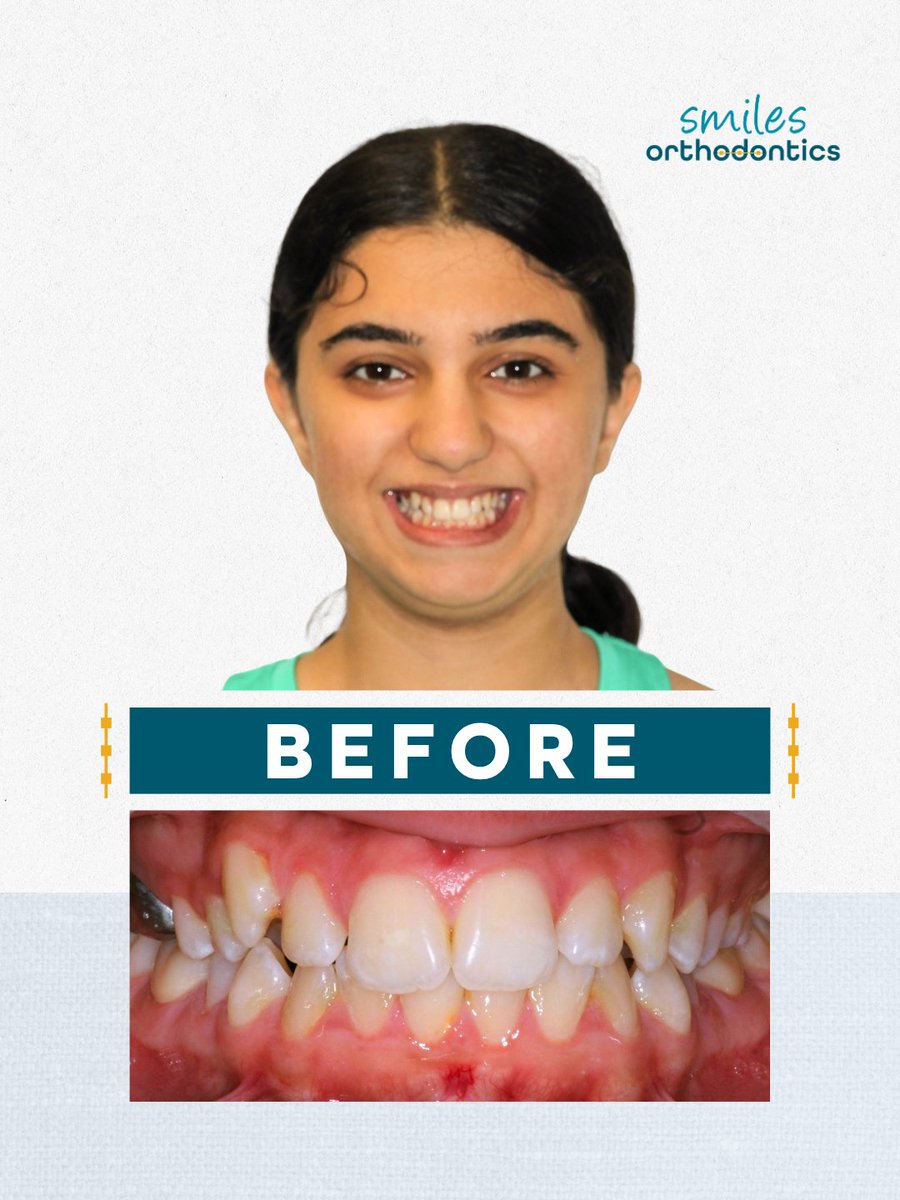 smilesortho's tweet photo. Braces off for Bahareh! 💙 We’re so happy to celebrate your beautiful smile with you at Smiles Orthodontics. Keep smiling! 😁

#BracesOff #Orthodontics #WichitaKS https://t.co/Y1rkl0dlxV