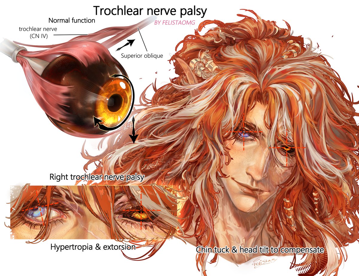 FeliStaOMG's tweet photo. Trochlear nerve palsy trend art
#art #OC #artwork #digitalart #arttrend https://t.co/aZB9BfBMDr