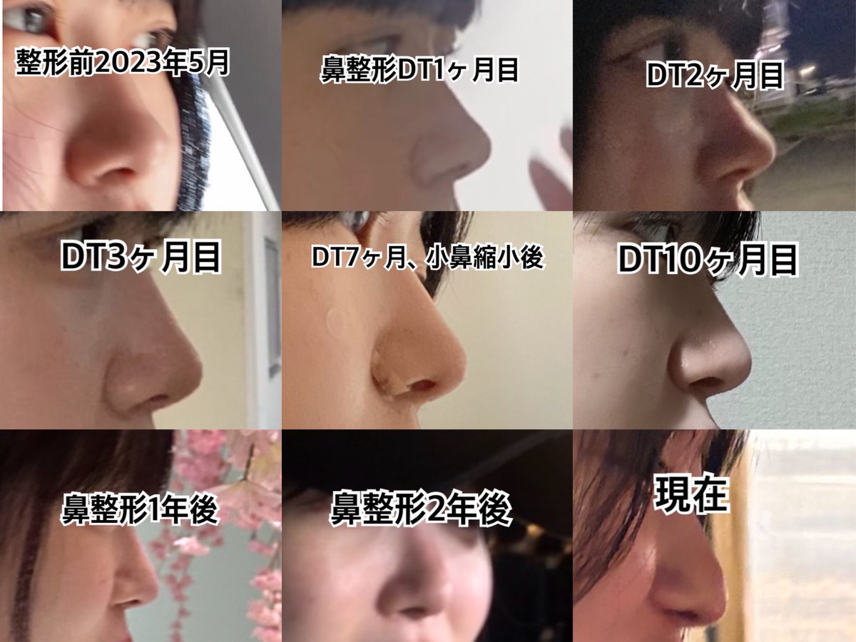 dpsnll's tweet photo. 鼻整形3年4ヶ月の変化
DT3ヶ月目まで高いアップノーズ
半年目から落ち着いて馴染んでいく
綺麗で満足ってなったのはDT10ヶ月目
1年ちょい経ってからプロテの透けを皮膚科の先生に指摘されるようになった

現在
鼻先吸収し低くなり魔女鼻に
笑うと↓この形。小鼻縮小は後戻り
鼻の歪み、プロテの透け https://t.co/gJbHRqjllP