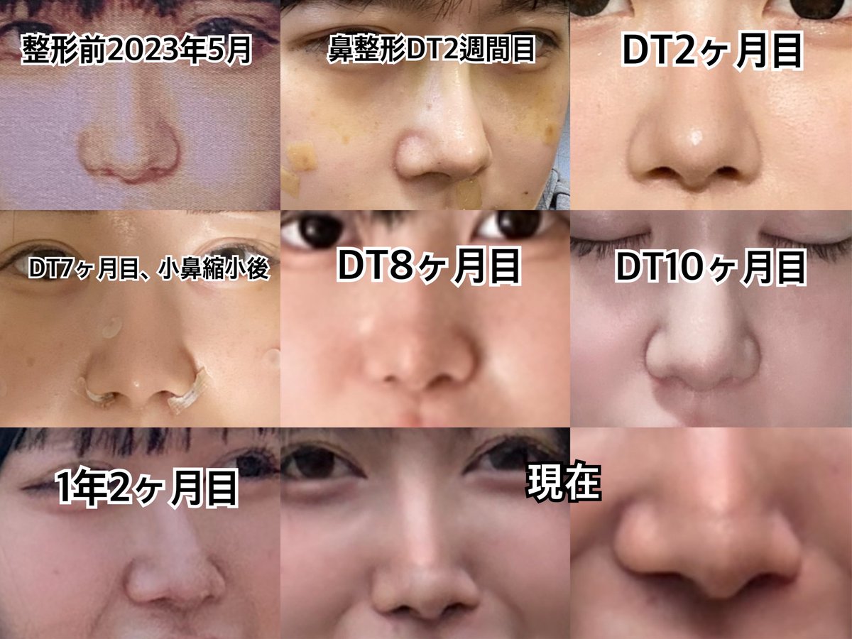 dpsnll's tweet photo. 鼻整形3年4ヶ月の変化
DT3ヶ月目まで高いアップノーズ
半年目から落ち着いて馴染んでいく
綺麗で満足ってなったのはDT10ヶ月目
1年ちょい経ってからプロテの透けを皮膚科の先生に指摘されるようになった

現在
鼻先吸収し低くなり魔女鼻に
笑うと↓この形。小鼻縮小は後戻り
鼻の歪み、プロテの透け https://t.co/gJbHRqjllP