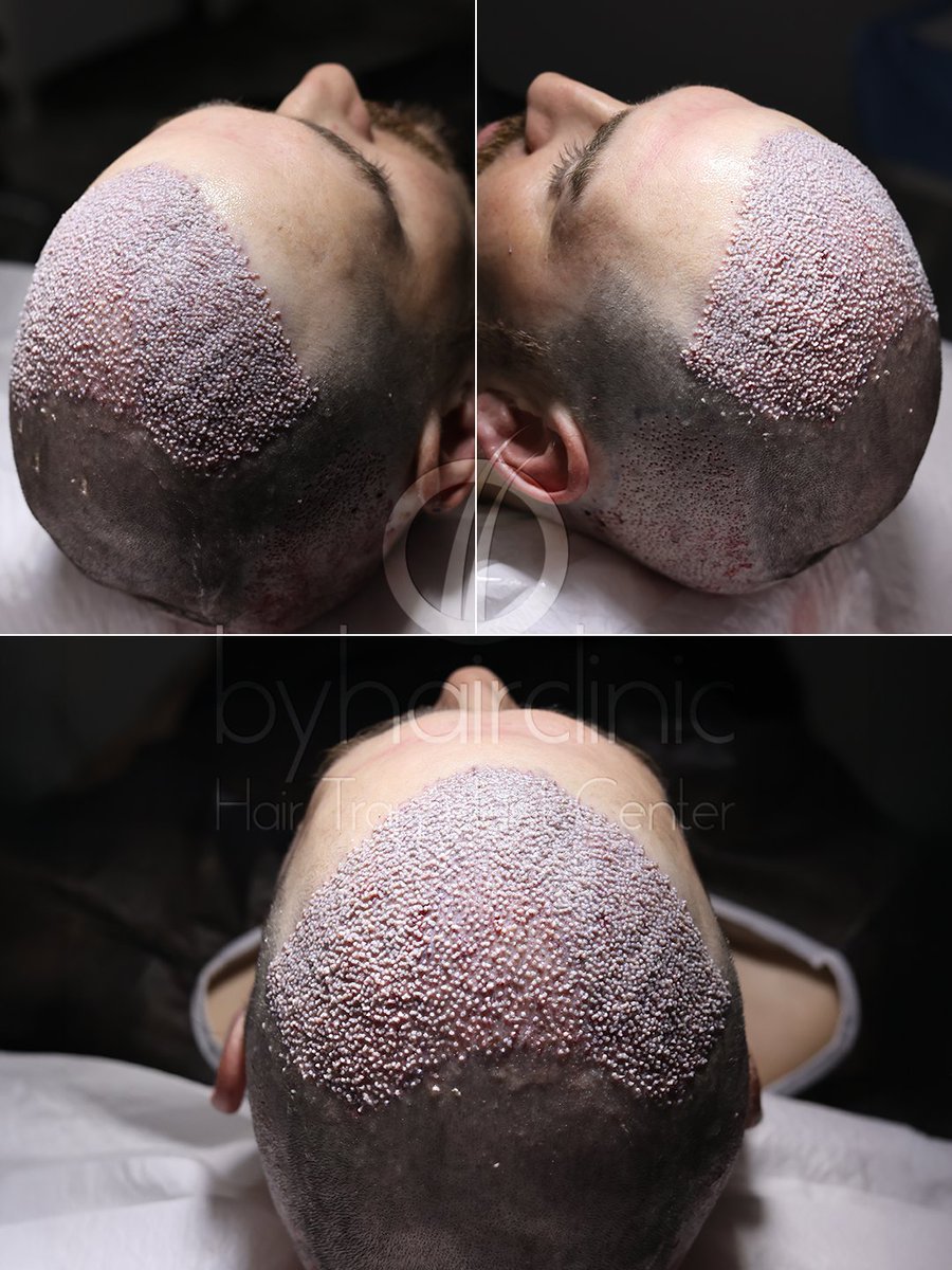 fue_hairclinic's tweet photo. Une transformation qui se construit étape par étape. ✨
De la planification de la ligne frontale jusqu’à l’implantation des greffons, chaque détail compte pour obtenir un résultat harmonieux et adapté au visage
https://t.co/G5FSzEv6EG
#greffedecheveux #greffecapillaire https://t.co/iHMdA1LA82