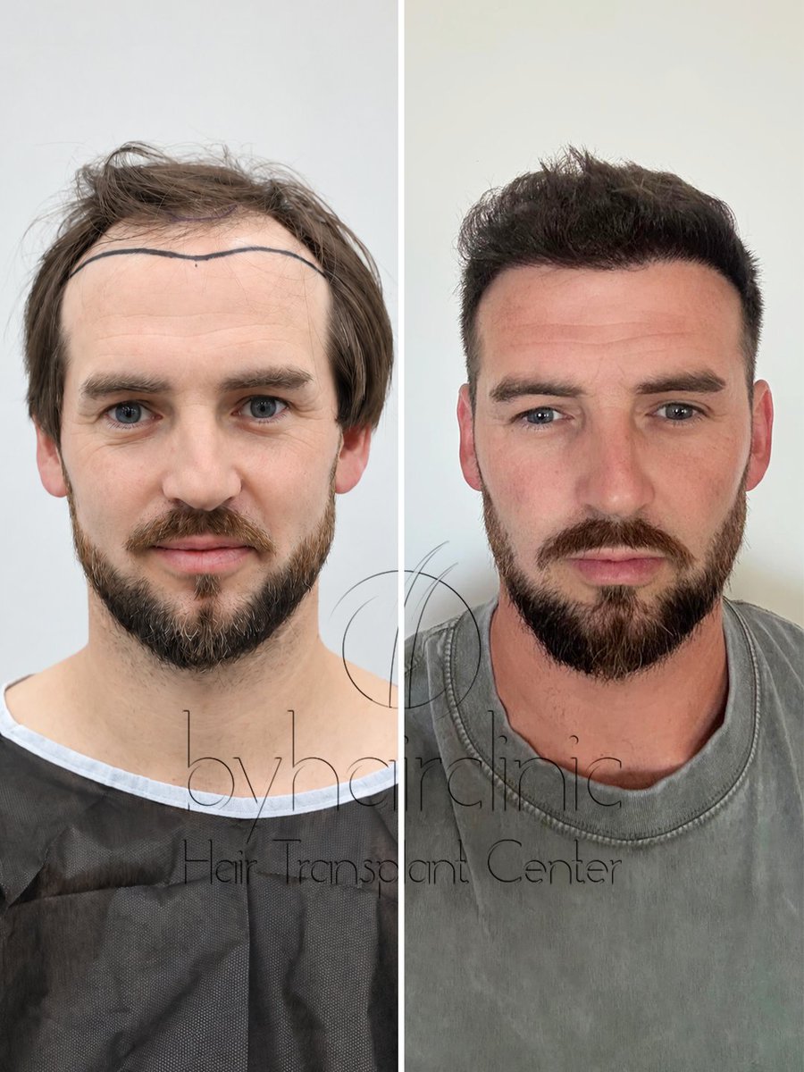 fue_hairclinic's tweet photo. Une transformation qui se construit étape par étape. ✨
De la planification de la ligne frontale jusqu’à l’implantation des greffons, chaque détail compte pour obtenir un résultat harmonieux et adapté au visage
https://t.co/G5FSzEv6EG
#greffedecheveux #greffecapillaire https://t.co/iHMdA1LA82