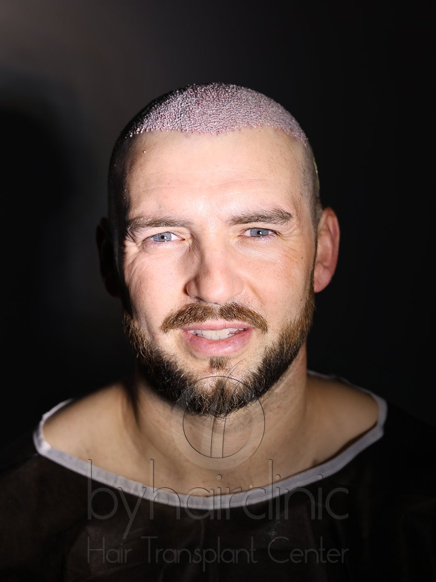 fue_hairclinic's tweet photo. Une transformation qui se construit étape par étape. ✨
De la planification de la ligne frontale jusqu’à l’implantation des greffons, chaque détail compte pour obtenir un résultat harmonieux et adapté au visage
https://t.co/G5FSzEv6EG
#greffedecheveux #greffecapillaire https://t.co/iHMdA1LA82