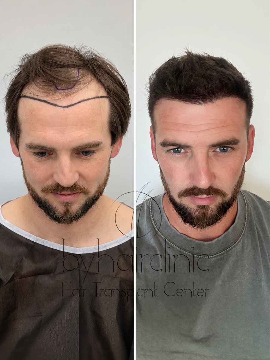 fue_hairclinic's tweet photo. Une transformation qui se construit étape par étape. ✨
De la planification de la ligne frontale jusqu’à l’implantation des greffons, chaque détail compte pour obtenir un résultat harmonieux et adapté au visage
https://t.co/G5FSzEv6EG
#greffedecheveux #greffecapillaire https://t.co/iHMdA1LA82