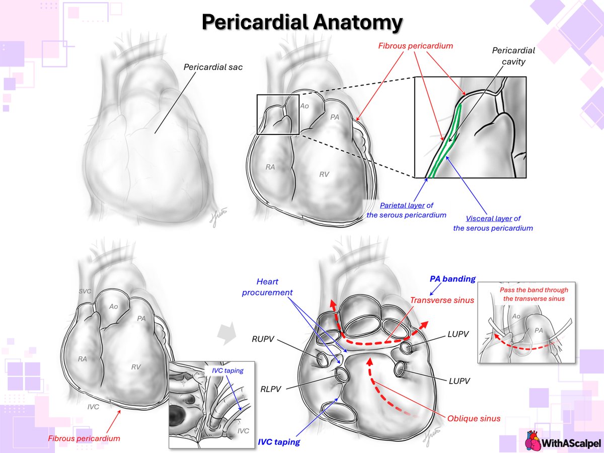 WithAScalpel's tweet photo. Pericardial Anatomy — Series: #1–2

👉The pericardium consists of fibrous and serous layers surrounding the heart, with a potential pericardial cavity between the parietal and visceral serous layers.
👉Posterior pericardial reflections form the transverse and oblique sinuses and define important surgical pathways around the great vessels and pulmonary veins.

↓ Full series below