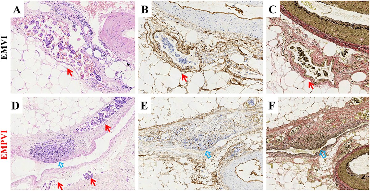 Human_Pathology's tweet photo. New in #HumPathol: Prognostic Value of the Extramural Perivenous Infiltration in Locally Advanced Gastric Cancer: A Retrospective Clinical Study. https://t.co/cbXHX9MDwP #pathology #PathTwitter #PathX #GIpath https://t.co/9v7UQSmlQL