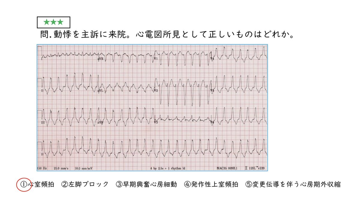 ka_mumuu's tweet photo. 【心電図クイズ#67の解答・ポイント】
正解は①心室頻拍でした

まずQRSが広いのが気になりますよね。んで、房室解離ありそう？R-Rが一定
心室頻拍かな。

検定ではR-R感覚が不整でWPW＋心房細動で早期興奮心房細動を選ばせる問題が出題されました（僕は間違った！）
・
#かむの心電図クイズ https://t.co/Eb5vvXpYW1