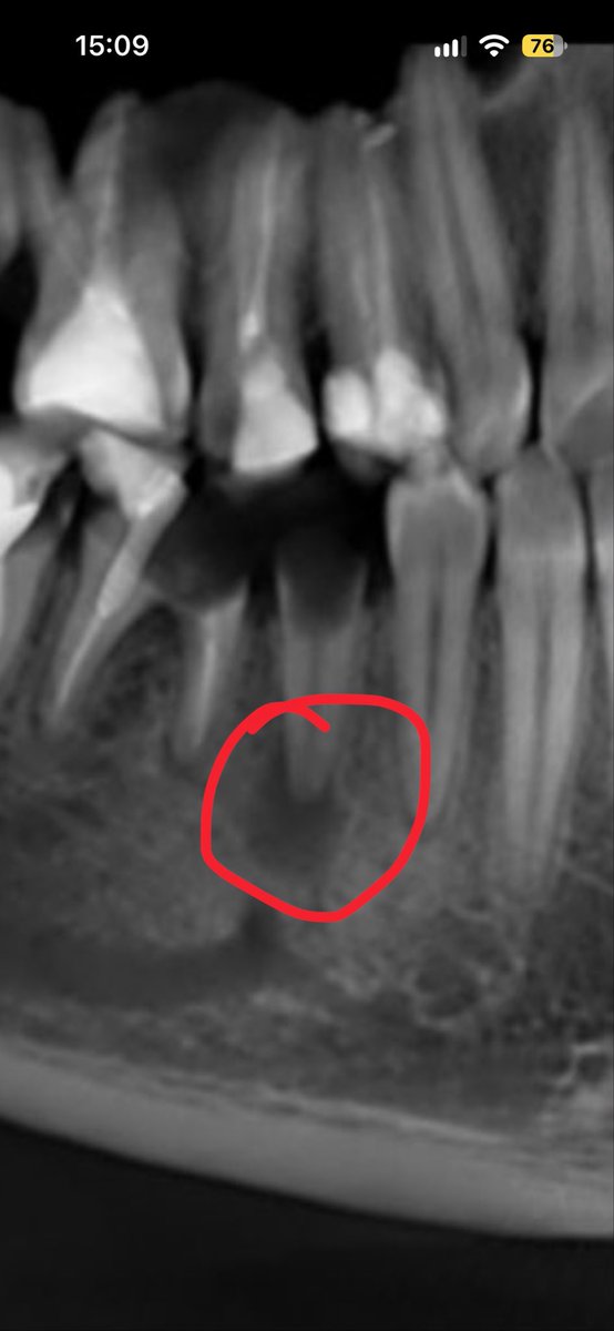 ex_six66's tweet photo. @iprxy_loh То, что зубы мёртвые - это не значит, что воспаление тканей возле корня не может быть. 

К слову особенно этот вообще не похож на мёртвый или что у него вообще лечили каналы. И под ним с большей долей вероятности темное пятно вряд ли тень. https://t.co/aNT8C42Kg3