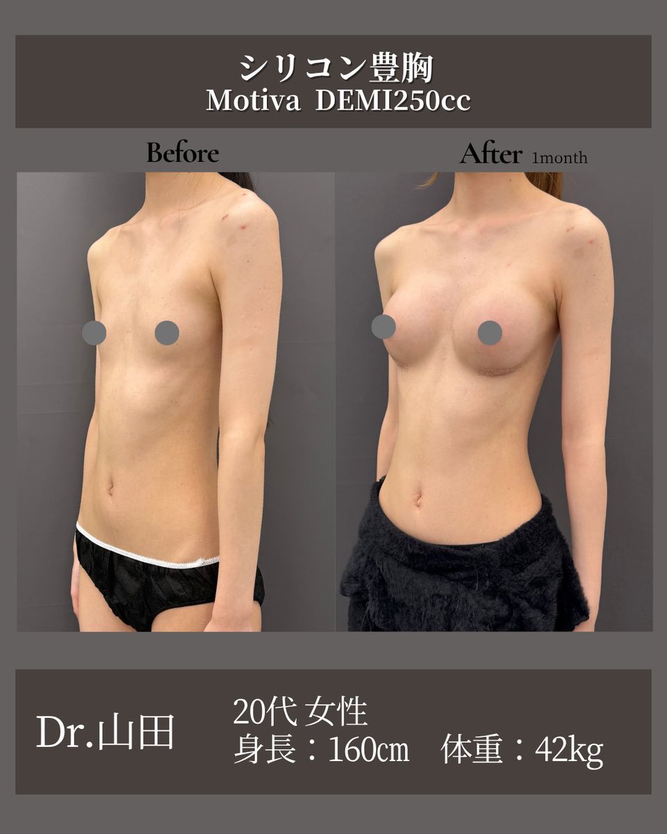 dr_atsuzo's tweet photo. 160cm42kgの方🥧

【シリコン豊胸・術後1ヶ月】
20代女性
160cm / 42kg
乳腺下 / 胸下切開

痩せ型でとてもスタイルのいい方です。
DEMIサイズのシリコンを使用することで
華やかなだけど自然なお胸に仕上がりました✨

まだ術後3ヶ月〜半年にかけて、ここからさらに馴染んで自然になっていきます☺️

⸻

💎 シリコン豊胸とは？
シリコンインプラントを挿入して、理想的なボリューム・形を作る手術です。
ハリと丸みを取り戻したい方におすすめです。

💎 当院で可能な豊胸術
・シリコン豊胸
・ハイブリッド豊胸（シリコン＋脂肪注入）
・脂肪豊胸

💎 リスク・合併症
・内出血・腫れ（2～3日、その後1～2週間で軽快）
・カプセル拘縮（インプラント特有の現象）
・切開部の傷跡（通常6～12ヶ月で馴染んで目立ちにくくなる）

💎 料金
《インプラント豊胸》
通常価格：770,000円／モニター：528,000円
《ハイブリッド豊胸》
通常価格：1,100,000円／モニター：770,000円
《脂肪豊胸》
通常価格：770,000円／モニター：580,000円

※診察料・採血・麻酔・テープ代は別途
初診料 2,200円／再診料 1,100円
デュアルプレーン法は＋20万円

⸻
#形成外科専門医
#お茶の水美容形成クリニック #吉井クリニック