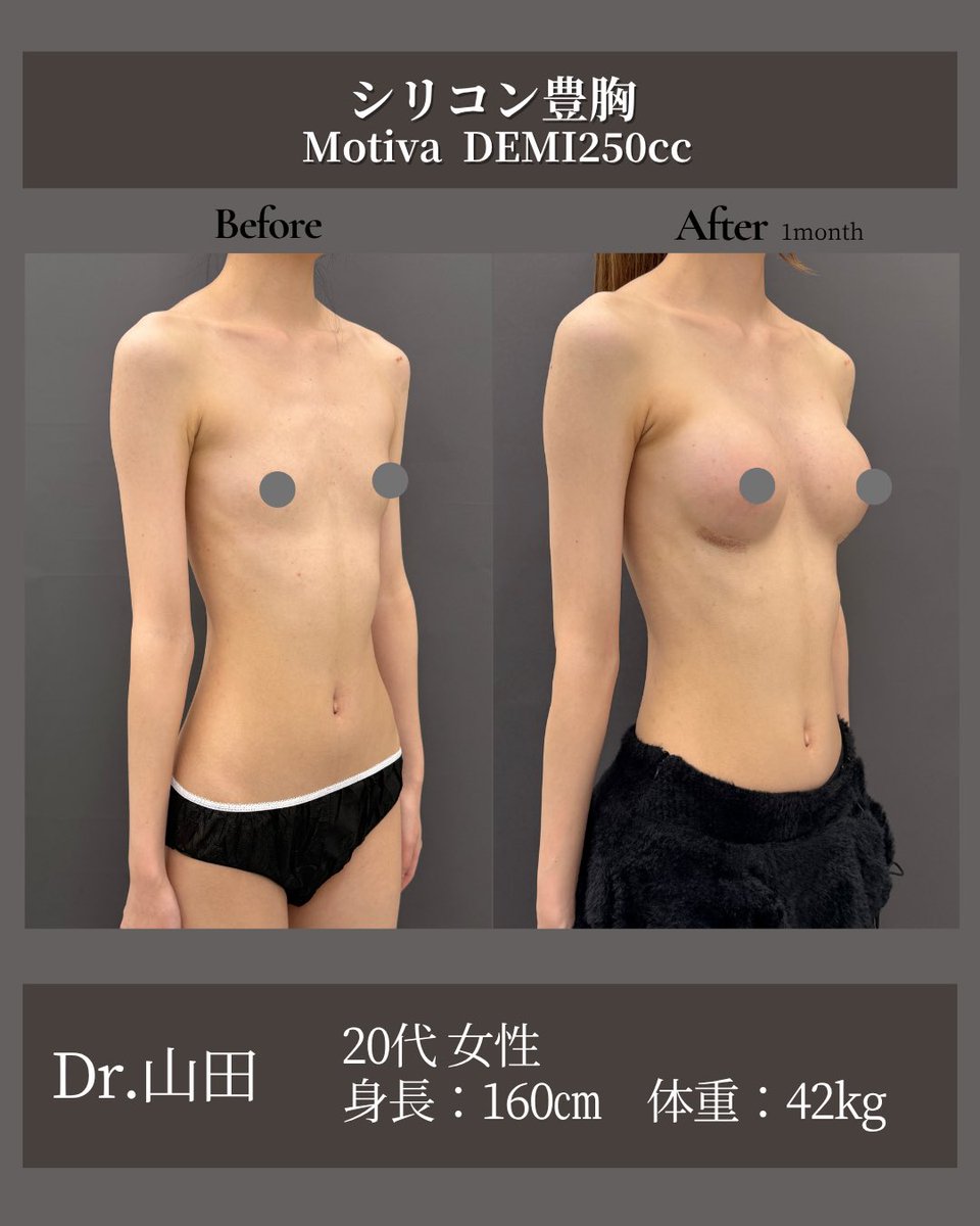 dr_atsuzo's tweet photo. 160cm42kgの方🥧

【シリコン豊胸・術後1ヶ月】
20代女性
160cm / 42kg
乳腺下 / 胸下切開

痩せ型でとてもスタイルのいい方です。
DEMIサイズのシリコンを使用することで
華やかなだけど自然なお胸に仕上がりました✨

まだ術後3ヶ月〜半年にかけて、ここからさらに馴染んで自然になっていきます☺️

⸻

💎 シリコン豊胸とは？
シリコンインプラントを挿入して、理想的なボリューム・形を作る手術です。
ハリと丸みを取り戻したい方におすすめです。

💎 当院で可能な豊胸術
・シリコン豊胸
・ハイブリッド豊胸（シリコン＋脂肪注入）
・脂肪豊胸

💎 リスク・合併症
・内出血・腫れ（2～3日、その後1～2週間で軽快）
・カプセル拘縮（インプラント特有の現象）
・切開部の傷跡（通常6～12ヶ月で馴染んで目立ちにくくなる）

💎 料金
《インプラント豊胸》
通常価格：770,000円／モニター：528,000円
《ハイブリッド豊胸》
通常価格：1,100,000円／モニター：770,000円
《脂肪豊胸》
通常価格：770,000円／モニター：580,000円

※診察料・採血・麻酔・テープ代は別途
初診料 2,200円／再診料 1,100円
デュアルプレーン法は＋20万円

⸻
#形成外科専門医
#お茶の水美容形成クリニック #吉井クリニック