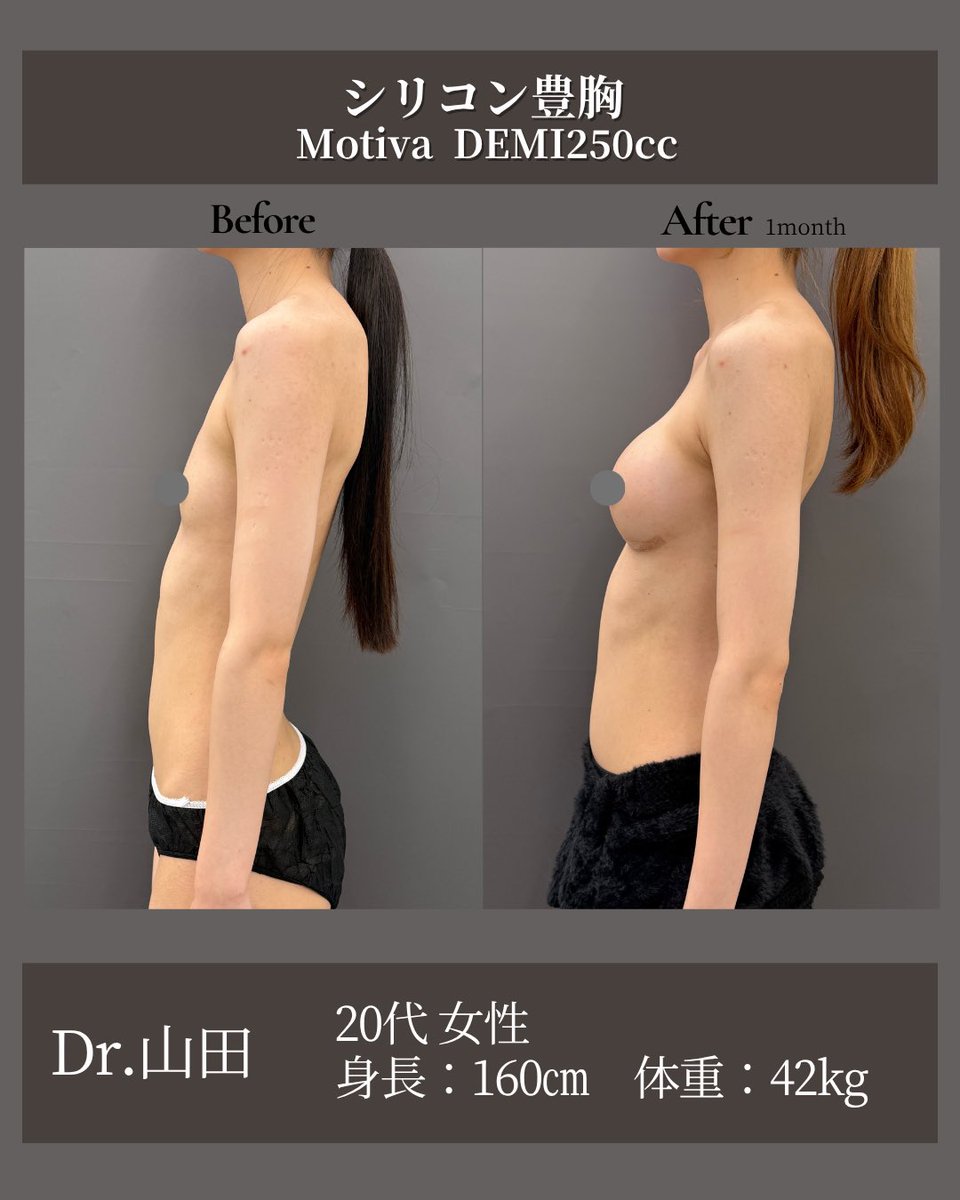 dr_atsuzo's tweet photo. 160cm42kgの方🥧

【シリコン豊胸・術後1ヶ月】
20代女性
160cm / 42kg
乳腺下 / 胸下切開

痩せ型でとてもスタイルのいい方です。
DEMIサイズのシリコンを使用することで
華やかなだけど自然なお胸に仕上がりました✨

まだ術後3ヶ月〜半年にかけて、ここからさらに馴染んで自然になっていきます☺️

⸻

💎 シリコン豊胸とは？
シリコンインプラントを挿入して、理想的なボリューム・形を作る手術です。
ハリと丸みを取り戻したい方におすすめです。

💎 当院で可能な豊胸術
・シリコン豊胸
・ハイブリッド豊胸（シリコン＋脂肪注入）
・脂肪豊胸

💎 リスク・合併症
・内出血・腫れ（2～3日、その後1～2週間で軽快）
・カプセル拘縮（インプラント特有の現象）
・切開部の傷跡（通常6～12ヶ月で馴染んで目立ちにくくなる）

💎 料金
《インプラント豊胸》
通常価格：770,000円／モニター：528,000円
《ハイブリッド豊胸》
通常価格：1,100,000円／モニター：770,000円
《脂肪豊胸》
通常価格：770,000円／モニター：580,000円

※診察料・採血・麻酔・テープ代は別途
初診料 2,200円／再診料 1,100円
デュアルプレーン法は＋20万円

⸻
#形成外科専門医
#お茶の水美容形成クリニック #吉井クリニック