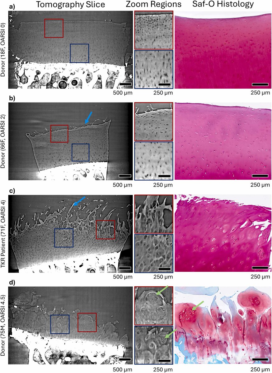 OACJournal's tweet photo. New in #OAC! Phase-contrast synchrotron microtomography of human articular #cartilage samples reveal age-related changes with similar fidelity as histology, while providing substantial additional quantitative information. 
Read more: https://t.co/rkXE7dVzo3 https://t.co/OoSTDm0ZqA