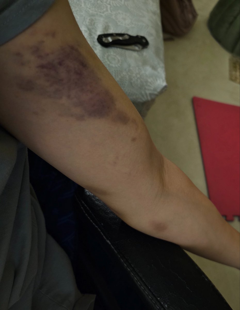 apmidsry's tweet photo. Bruised biceps from fighting https://t.co/uFlUpIHWIU