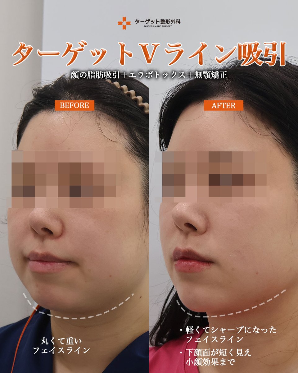 targetpsjp's tweet photo. 【ターゲットVライン吸引の症例】

BEFORE　　　　→　　　　AFTER

✔️ 軽くシャープなフェイスライン
✔️ 下顔面がすっきりして小顔効果も◎

施術前は、顎下やフェイスラインに脂肪がついており、丸く重たく見える印象でした。

★ ターゲットVライン吸引（顔の脂肪吸引）
★ エラボトックス
★ 無顎矯正

により、フェイスラインをすっきりと整え、軽やかでシャープな印象へ。

下顔面もすっきりと見え、よりバランスの整ったVラインに仕上がりました。

ターゲット整形外科では、脂肪吸引とエラボトックスなどを組み合わせ、一人ひとりのフェイスラインに合わせた施術をご提案しています。

ご予約・お問い合わせは公式LINEから📩
📩公式LINE：https://t.co/mSb3PVcQRd

#顔の脂肪吸引 #エラボトックス #フェイスライン #Vライン #小顔整形 #韓国美容整形 #ターゲット整形外科