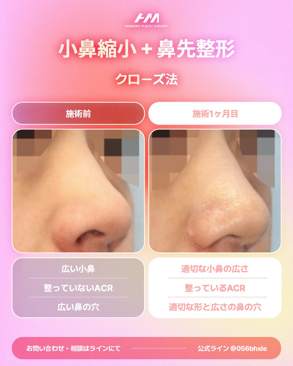 harmonypsjp's tweet photo. 「小鼻が広く見える…
でも手術とかオープン法はしたくない…」

そんな鼻のお悩みに、

小鼻縮小＋鼻先整形（クローズ法）という選択肢💗

今回の症例では、
広く見えていた小鼻と鼻の穴を整えながら、
鼻先の形・バランスも調整した症例です。

施術前と比べて、
✔ 小鼻の広がりをすっきり
✔ 鼻の穴の形・大きさを調整
✔ ACRを整えて自然な鼻先へ

ハーモニー美容外科は、一人ひとりの鼻の形・幅・バランスに合わせた自然な仕上がりを目指します🤍

📩 ご相談・お問い合わせは公式LINEまで
💗公式LINE： https://t.co/tt2S9u00CP

#整形垢 #渡韓整形 #鼻先整形 #美容垢 #小鼻縮小 #鼻整形 #韓国代行 #韓国クリニック #美容クリニック