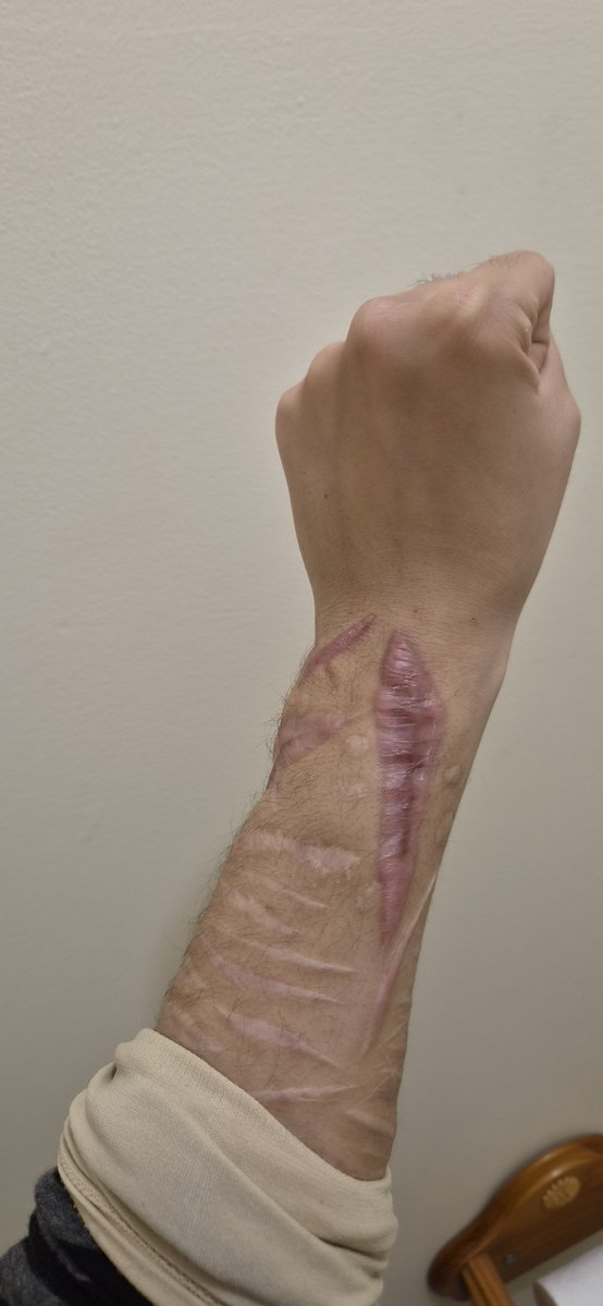 xxsxrenxx's tweet photo. Is this gross?

SFX makeup https://t.co/w4syL0sFwz