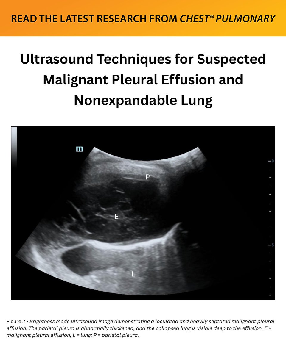 journal_CHEST's tweet photo. A #Journal_CHESTPulm review explores the potential of various ultrasound techniques as a noninvasive tool for the workup of suspected malignant pleural effusion.
Read the article in the September issue: https://t.co/eBXJqBXFHV
#MedEd #JournalCHEST https://t.co/TB1Lm0gtNu