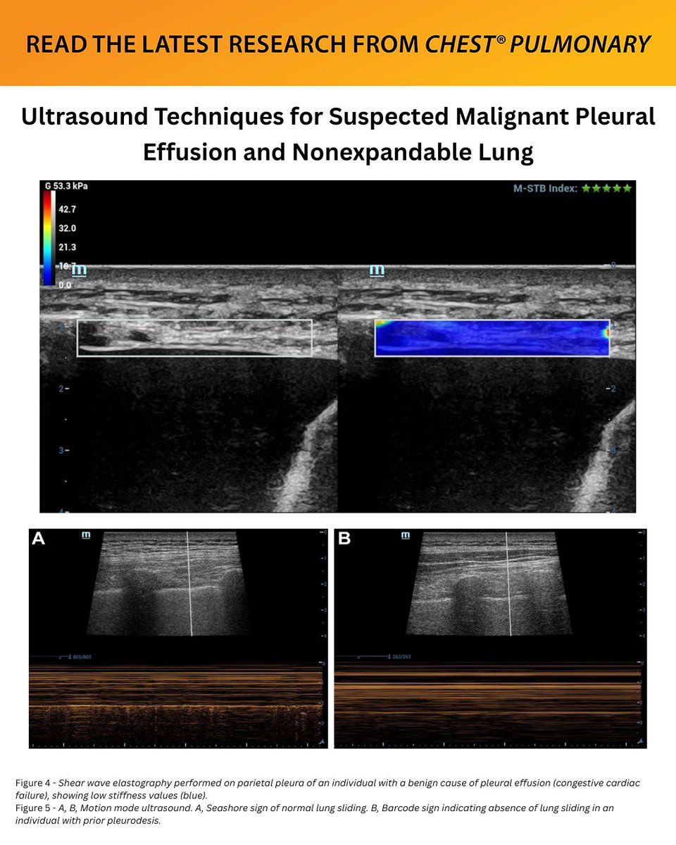 accpchest's tweet photo. A #Journal_CHESTPulm review explores the potential of various ultrasound techniques as a noninvasive tool for the workup of suspected malignant pleural effusion.
Read the article in the September issue: https://t.co/xFYcMBR9C3
#MedEd #JournalCHEST https://t.co/mu4TCvia3J