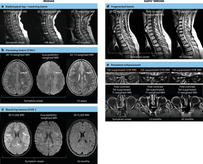 NatRevNeurol's tweet photo. New online! Use of MRI in neuromyelitis optica spectrum disorder and myelin oligodendrocyte glycoprotein antibody-associated disease — MAGNIMS consensus recommendations https://t.co/2YkWgnCdJY https://t.co/ABpj2A4G4D