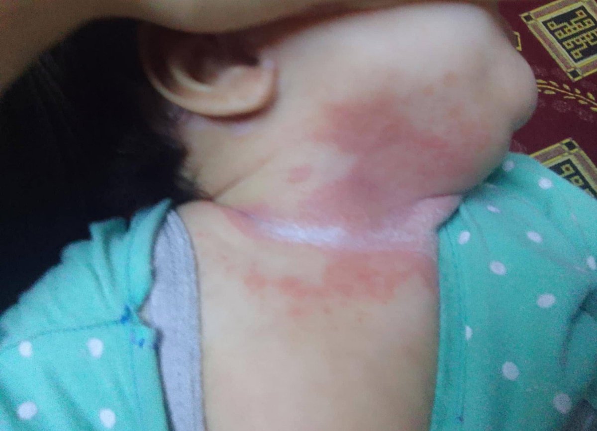 _nesmam's tweet photo. Urgent emergency 🛑
The pain is indescribable. Our children are suffering from skin rashes in the tents. I'm not asking for much; I just want the money for treatment before it's too late. Their skin is melting and bleeding pls⬇️
https://t.co/Nq6mcFhlTL
Or
https://t.co/bOeL67uk2c https://t.co/P5IFDUC7PK