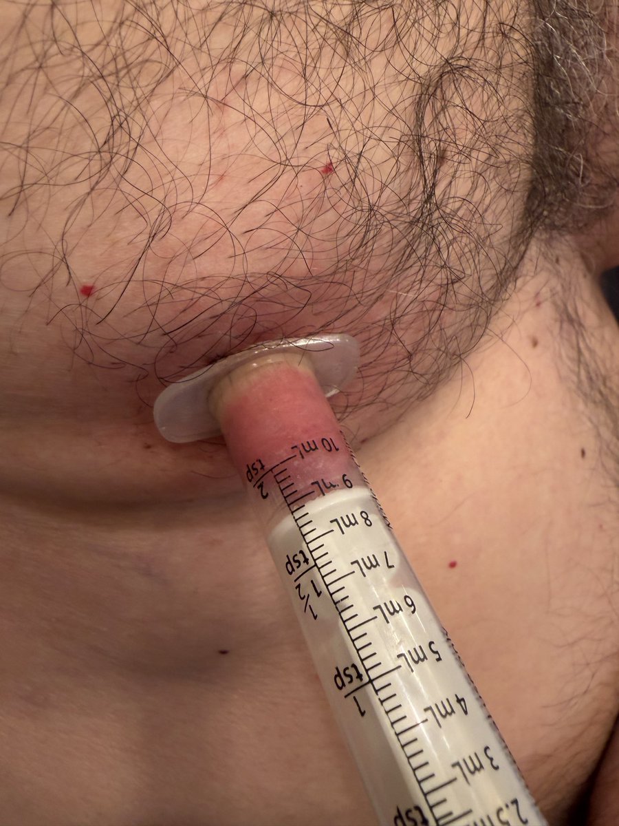 Richard01581270's tweet photo. Nipple stretching with suction. #nippleplay #nipplepumping #nipplestretching https://t.co/cl6dDmOiRV