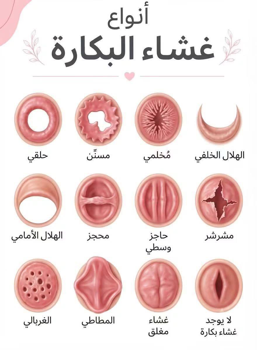 Shahdmep0's tweet photo. اكثر وحده تعاني لليله الدخله المغلق 

ولشباب ترى في غشاء مفتوح احتمال لا يوجد دم 🩸 

عدم اتهام الشرف قبل التأكد من الطبيب https://t.co/pu83NeNJrG