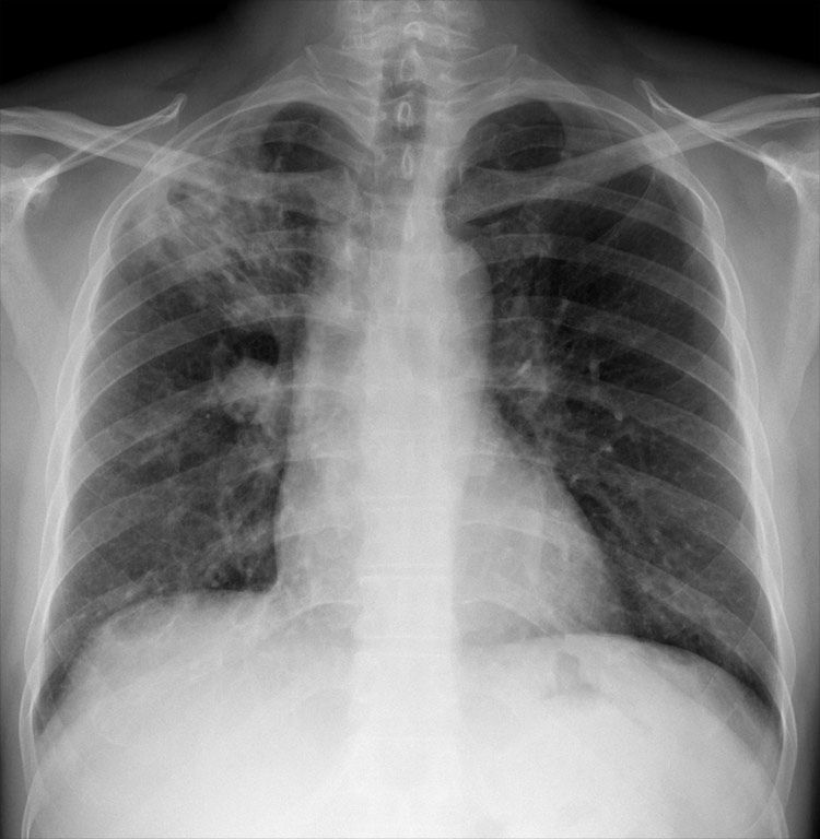 RadMasterclass's tweet photo. X-RAY QUIZ: Cough. What is the most likely cause of the chest X-ray appearances?
A: Pulmonary oedema
B: Lung metastases
C: Tuberculosis infection
D: Previous spontaneous pneumothorax
E: Sarcoidosis
Start Quiz https://t.co/v6wtWrkJot https://t.co/4jevAqvXLS