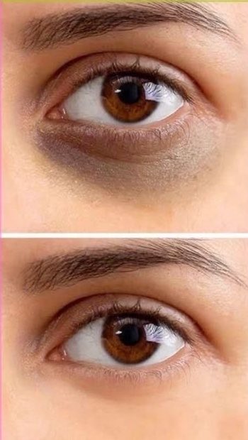 HealthyAlfred's tweet photo. one bacteria might be why your dark circles never go away.

not sleep. not screens. not genetics.

there's a catch, and it's where it lives.

H. pylori burrows into your stomach lining and blocks iron absorption. less iron, less oxygen in the blood.

the skin under your eyes is the thinnest on your body. when the blood underneath carries less oxygen, you see it.

it blocks B12 too. that's the pale, washed-out look that comes with it.

43.9% of adults are carrying it. most picked it up as children.

(PMID: 38176660)

you've been buying eye cream for something living three feet lower.

a breath test finds it in fifteen minutes. almost nobody orders one.

what kills it is in the comments ↓