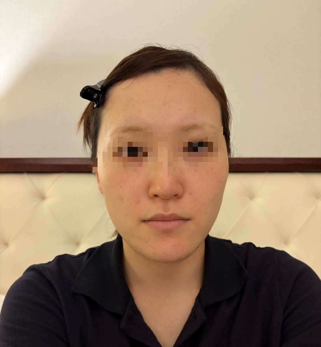rstiz7's tweet photo. 輪郭3点＋両顎して2週間経過
痣はまだ大分目立つけど腫れは少し引いてきた！
これからが楽しみ！
 #ビュー美容外科 https://t.co/SGywmIh55q