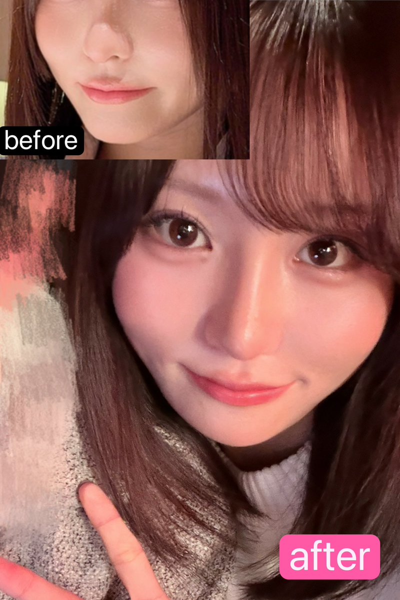 wj4616's tweet photo. ジャスト美容外科(@justprsjp )でデュアルピーチリフト施術してから2週間経った🍑

腫れ引いて施術した時の傷も分からなくなりましたჱ̒ ᴗ ̫ ᴗ

クマとほうれい線が目立ちにくくなったのと、とくに頬がのっぺりしてる感じが改善されてる！これ伝わるかなー😣

左上がbeforeで下がafter https://t.co/NxKLjjbOFC