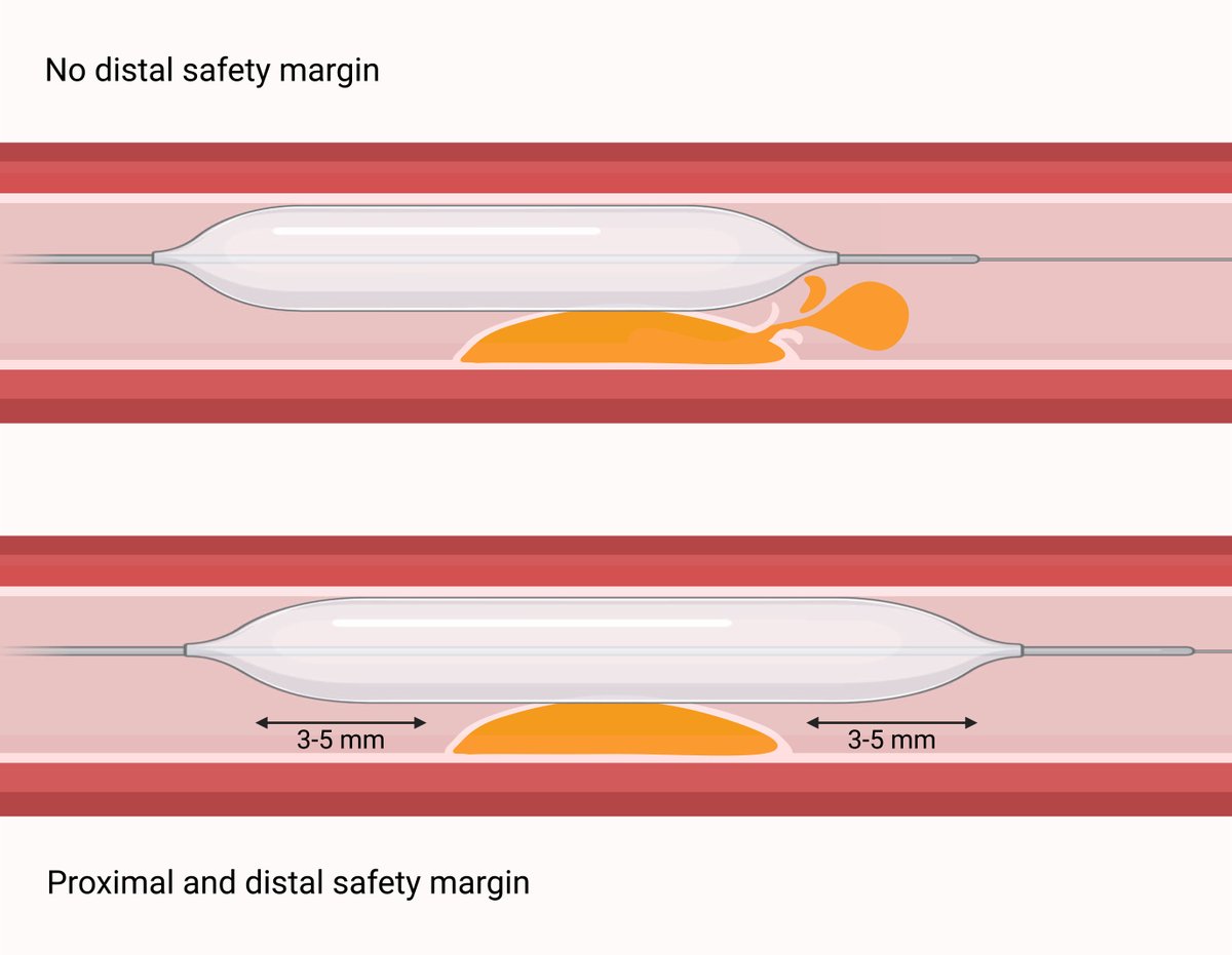 MyJSCAI's tweet photo. 📖Could drug-coated balloons become a novel strategy for stabilizing vulnerable plaques? Comprehensive review of vulnerable plaque detection, preventive PCI, & the emerging role of drug-coated balloons. #VulnerablePlaque #PCI #DCB Read now in #JSCAI 

➡️https://t.co/5NlMTfRvr2 

@BimmerClaessen @hect2701