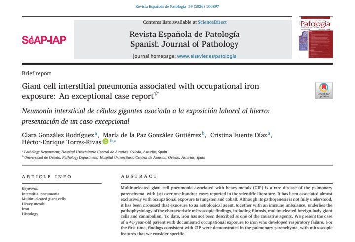 duckhuca's tweet photo. ✅ We are pleased to share our latest paper.
🫁 Giant cell interstitial pneumonia associated with occupational iron exposure.
1️⃣ First histological description with pathognomonic findings.
🆓 Limited-time download .
🔗 https://t.co/74I3PmwYcg https://t.co/xYr5B0S2Ex