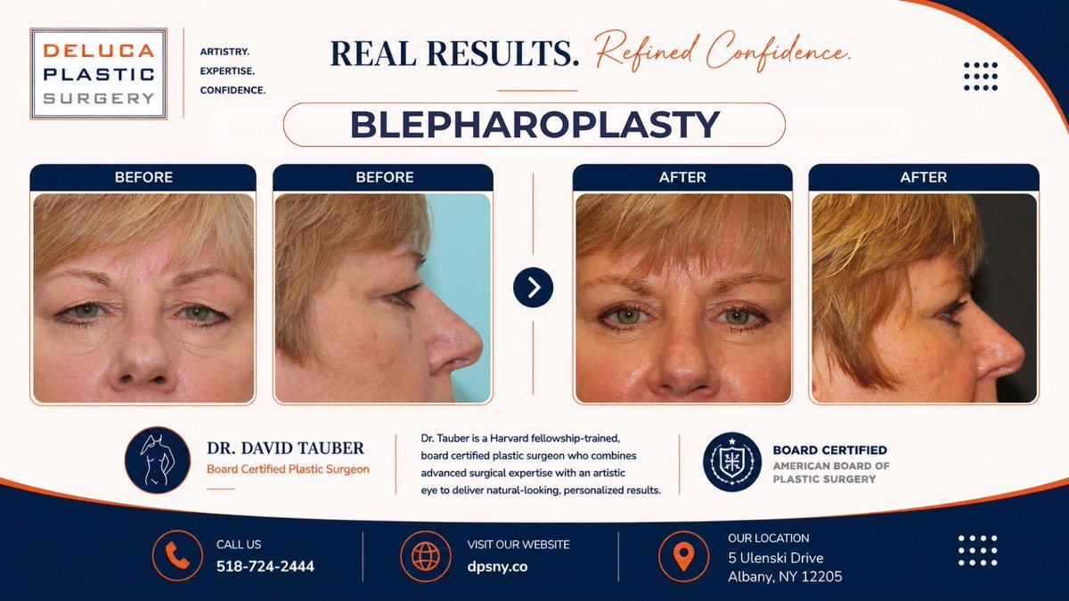 DMTauberMD's tweet photo. Brighter, more refreshed eyes with beautifully natural results. ✨👁️🧡💙
Dr. Tauber personalized this blepharoplasty to complement the patient’s natural features.
#Blepharoplasty #BeforeAndAfter #AlbanyNY https://t.co/lFhPo0QArw